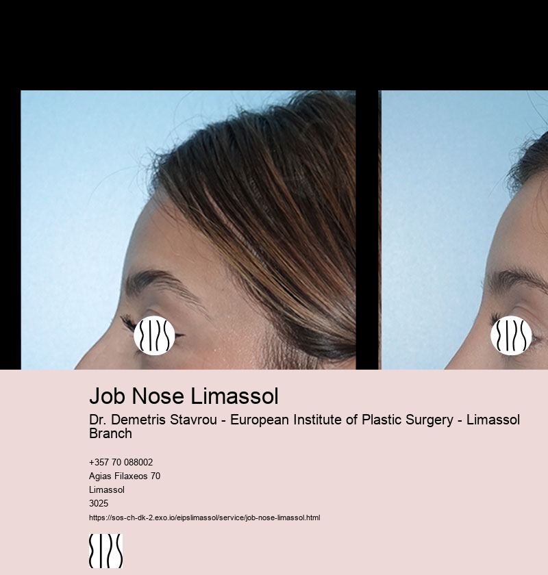 Job Nose Limassol