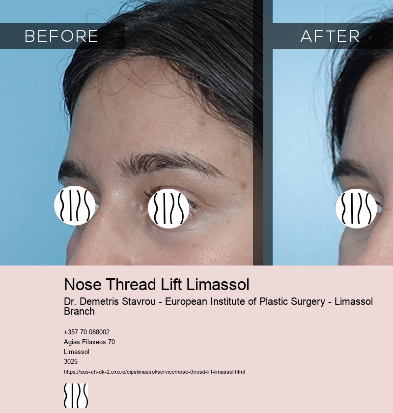 Nose Thread Lift Limassol