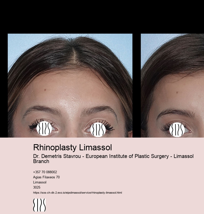 Rhinoplasty Limassol