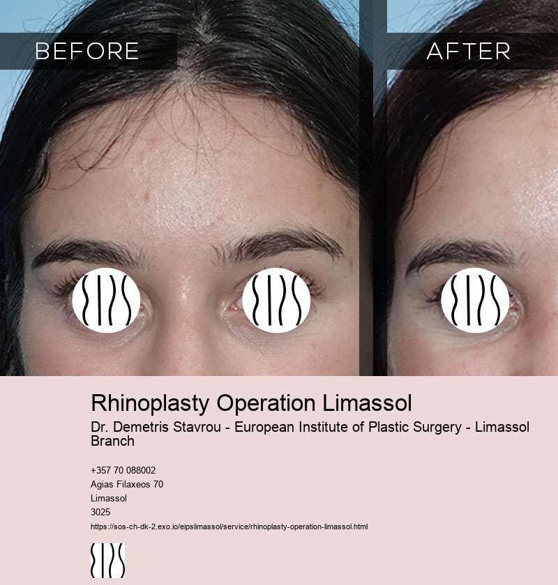 Rhinoplasty Operation Limassol