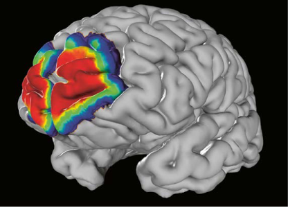 Noninvasive Sensors for Brain–Machine Interfaces Based on Micropatterned  Epitaxial Graphene