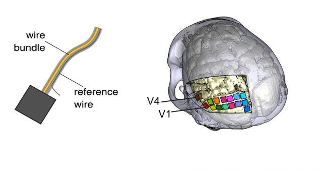 First human implantation of the WFMA for intracortical visual prosthesis -  Microprobes for Life Science